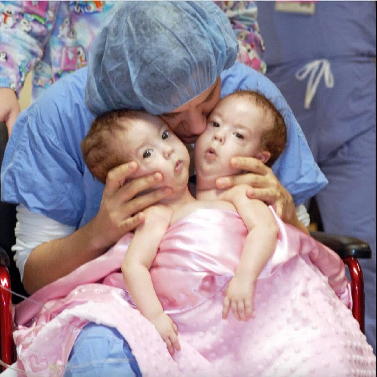 Conjoined twins were connected from birth, but surgery permanently changed everything